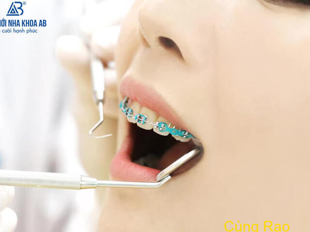 Quá trình niềng răng được diễn ra như nào ?