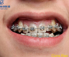 Quá trình niềng răng được diễn ra như nào ?