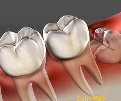 Răng khôn là gì ? Có nên nhổ răng khôn không ?