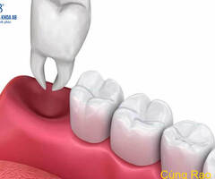 Răng khôn là gì ? Có nên nhổ răng khôn không ?