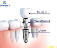 Cấu tạo răng Implant và các loại trụ Implant phổ biến hiện nay