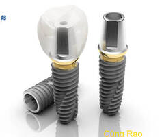 Cấu tạo răng Implant và các loại trụ Implant phổ biến hiện nay