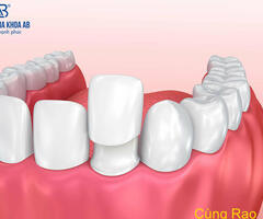 Những trường hợp bạn nên bọc răng sứ thẩm mỹ tại nha khoa