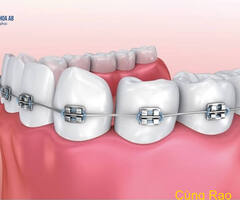 Các loại mắc cài niềng răng sử dụng phổ biến hiện nay